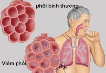 biến chứng viêm phổi