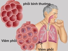biến chứng viêm phổi